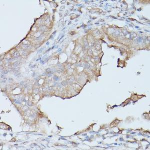 Immunohistochemistry analysis of paraffin-embedded human oophoroma using Anti-CEACAM1 Antibody (A11472) at a dilution of 1:100 (40X lens). Perform high pressure antigen retrieval with 10 mM citrate buffer pH 6.0 before commencing with IHC staining protocol