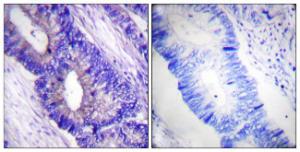 Immunohistochemical analysis of paraffin-embedded human colon carcinoma using Anti-PKA CAT (phospho Thr197) Antibody. The right hand panel represents a negative control, where the antibody was pre-incubated with the immunising peptide