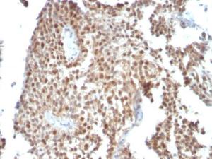 Immunohistochemical analysis of formalin-fixed, paraffin-embedded human bladder carcinoma using Anti-p53 Antibody [SPM590]