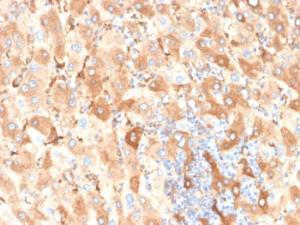 Immunohistochemical analysis of formalin-fixed, paraffin-embedded human liver carcinoma in colon using Anti-Albumin Antibody [ALB/6409R]