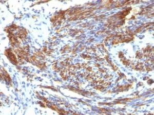 Immunohistochemical analysis of formalin-fixed, paraffin-embedded human leiomyosarcoma using Anti-Caldesmon Antibody [CALD1/820]