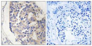 Immunohistochemical analysis of paraffin-embedded human breast carcinoma tissue using Anti-C1S Antibody The right hand panel represents a negative control, where the antibody was pre-incubated with the immunising peptide