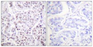 Immunohistochemical analysis of paraffin-embedded human breast carcinoma tissue using Anti-Histone H4 (acetyl Lys5) Antibody. The right hand panel represents a negative control, where the antibody was pre-incubated with the immunising peptide