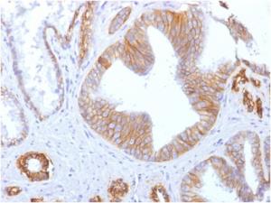 Immunohistochemical analysis of formalin-fixed, paraffin-embedded human prostate carcinoma using Anti-E Cadherin Antibody [SPM471]