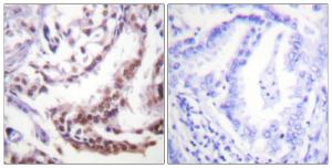 Immunohistochemical analysis of paraffin-embedded human lung carcinoma tissue using Anti-Histone H3 (acetyl Lys9) Antibody. The right hand panel represents a negative control, where the antibody was pre-incubated with the immunising peptide.