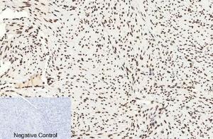 Immunohistochemical analysis of paraffin-embedded human uterus cancer tissue using Anti-Histone H3 (acetyl Lys9) Antibody at 1:200 (4°C overnight). Negative control was secondary antibody only.