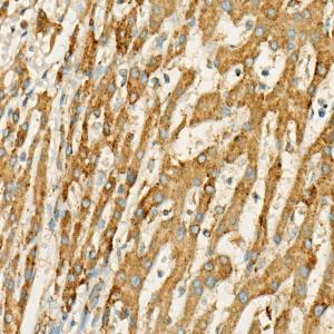 Immunohistochemistry analysis of paraffin-embedded human liver cancer using Anti-MX1 Antibody (A11481) at a dilution of 1:50 (40x lens). Perform high pressure antigen retrieval with 10 mM citrate buffer pH 6.0 before commencing with IHC staining protocol.