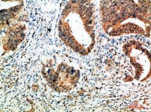 Immunohistochemical analysis of paraffin-embedded human colon cancer using Anti-ALB Antibody