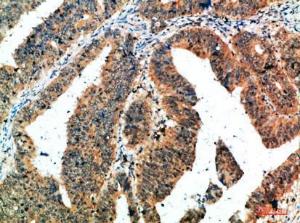 Immunohistochemical analysis of paraffin-embedded human colon cancer using Anti-ALB Antibody