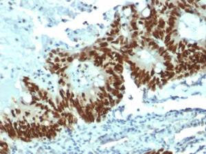 Immunohistochemical analysis of formalin-fixed, paraffin-embedded human colon carcinoma using Anti-p53 Antibody [DO-1]