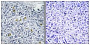 Immunohistochemical analysis of paraffin-embedded human breast carcinoma using Anti-TOP2A (phospho Ser1106) Antibody. The right hand panel represents a negative control, where the antibody was pre-incubated with the immunising peptide