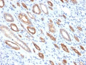 Immunohistochemical analysis of formalin-fixed, paraffin-embedded human renal cell carcinoma using Anti-Occludin Antibody [OCLN/2181]