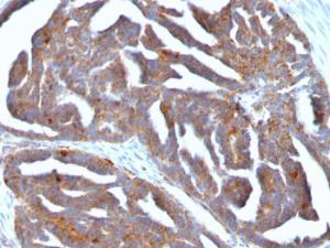 Immunohistochemical analysis of formalin-fixed, paraffin-embedded human ovarian tumor using Anti-GnRHR Antibody [F1G4]