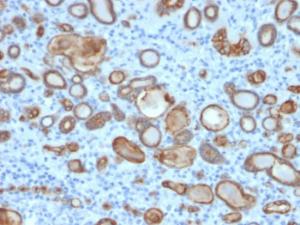 Immunohistochemical analysis of formalin-fixed, paraffin-embedded human thyroid carcinoma using Anti-Occludin Antibody [OCLN/2181]