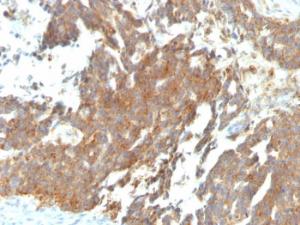 Immunohistochemical analysis of formalin-fixed, paraffin-embedded human ovarian tumor using Anti-GnRHR Antibody [GNRHR/768]