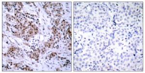 Immunohistochemical analysis of paraffin-embedded human breast carcinoma tissue using Anti-Estrogen Receptor-alpha Antibody. The right hand panel represents a negative control, where the antibody was pre-incubated with the immunising peptide.