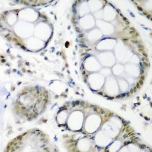 Immunohistochemistry analysis of paraffin-embedded human colon carcinoma tissue using Anti-Cdc27 Antibody (A11494) at a dilution of 1:200 (40x lens). Perform microwave antigen retrieval with 10 mM PBS buffer pH 7.2 before commencing with IHC staining protocol.