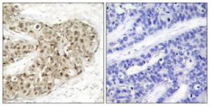 Immunohistochemical analysis of paraffin-embedded human breast carcinoma using Anti-CDC25C (phospho Ser216) Antibody. The right hand panel represents a negative control, where the Antibody was pre-incubated with the immunising peptide