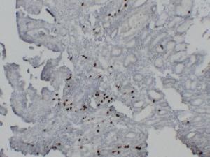 Immunohistochemical analysis of paraffin-embedded human Gastric adenocarcinoma using Anti-Gastrin Antibody