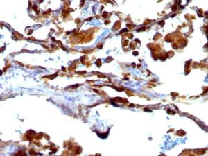 Immunohistochemical analysis of formalin-fixed, paraffin-embedded human lung carcinoma using Anti-MUC1 Antibody [VU-4H5]