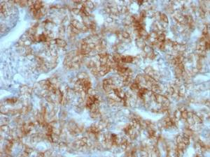 Immunohistochemical analysis of formalin-fixed, paraffin-embedded human renal cell carcinoma using Anti-Cadherin 16 Antibody [CDH16/1071]