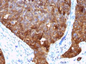 Immunohistochemical analysis of formalin-fixed, paraffin-embedded human colon carcinoma using Anti-MUC1 Antibody [VU-4H5]