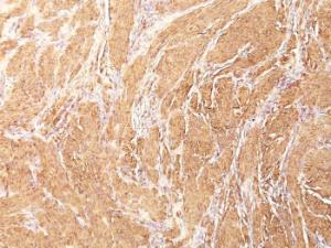 Immunohistochemical analysis of formalin-fixed, paraffin-embedded human leiomyosarcoma using Anti-Muscle Actin Antibody [HHF35]