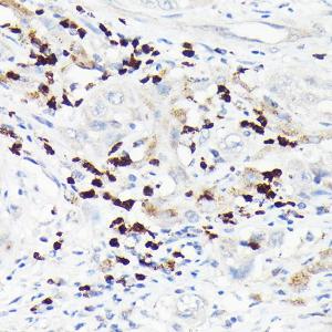 Immunohistochemistry analysis of paraffin-embedded human liver cancer using Anti-MMP8 Antibody (A11496) at a dilution of 1:100 (40X lens). Perform high pressure antigen retrieval with 10 mM citrate buffer pH 6.0 before commencing with IHC staining protocol