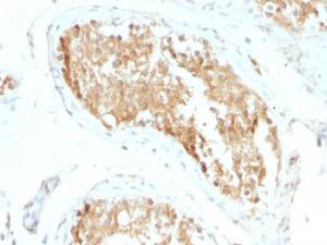 Immunohistochemical analysis of formalin-fixed, paraffin-embedded human testicular carcinoma using Anti-ALDH1A1 Antibody [ALDH1A1/1381]