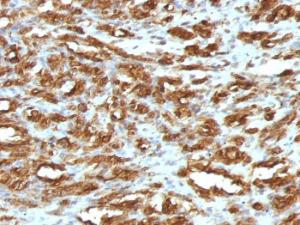 Immunohistochemical analysis of formalin-fixed, paraffin-embedded human rhabdomyosarcoma using Anti-Muscle Actin Antibody [HHF35]