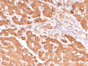 Immunohistochemical analysis of formalin-fixed, paraffin-embedded human colon carcinoma in tonsil using Anti-ALDH1A1 Antibody [ALDH1A1/4793]