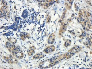 Anti-ROR1 Antibody (A82693) (5µg/ml) staining of paraffin embedded Human Breast Cancer. Heated antigen retrieval with citrate buffer pH 6, DAB-staining.