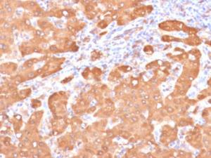 Immunohistochemical analysis of formalin-fixed, paraffin-embedded human colon carcinoma in tonsil using Anti-ALDH1A1 Antibody [ALDH1A1/4793]