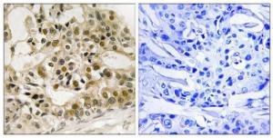 Immunohistochemical analysis of paraffin-embedded human breast carcinoma using Anti-Myb (phospho Ser532) Antibody. The right hand panel represents a negative control, where the antibody was pre-incubated with the immunising peptide