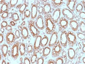 Immunohistochemical analysis of formalin-fixed, paraffin-embedded human renal cell carcinoma using Anti-Calnexin Antibody [CANX/1543]