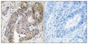 Immunohistochemical analysis of paraffin-embedded human colon carcinoma using Anti-CAD (phospho Thr456) Antibody. The right hand panel represents a negative control, where the antibody was pre-incubated with the immunising peptide