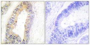 Immunohistochemical analysis of paraffin-embedded human colon carcinoma tissue using Anti-ZNF638 Antibody. The right hand panel represents a negative control, where the antibody was pre-incubated with the immunising peptide