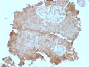 Immunohistochemical analysis of formalin-fixed, paraffin-embedded human bladder carcinoma using Anti-FAT2 Antibody [8C5]