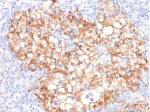 Immunohistochemical analysis of formalin-fixed, paraffin-embedded human renal cell carcinoma using Anti-Cadherin 16 Antibody [CDH16/2125]