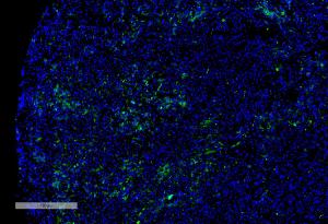 Immunohistochemistry analysis of human liver cancer