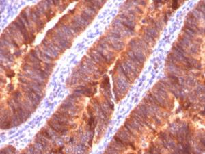 Immunohistochemical analysis of formalin-fixed, paraffin-embedded human colon carcinoma using Anti-MUC1 Antibody [MUC1/520]