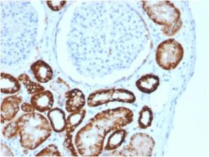 Immunohistochemical analysis of formalin-fixed, paraffin-embedded human renal cell carcinoma using Anti-Cadherin 16 Antibody [CDH16/2125]