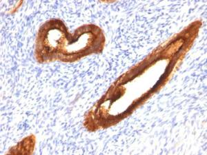 Immunohistochemical analysis of formalin-fixed, paraffin-embedded human endometrial carcinoma using Anti-MUC1 Antibody [MUC1/520]