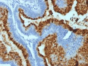 Immunohistochemical analysis of formalin-fixed, paraffin-embedded human colon carcinoma using Anti-Blood Group Antigen B Antibody [HEB-20]