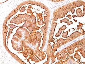 Immunohistochemical analysis of formalin-fixed, paraffin-embedded human breast carcinoma using Anti-MUC1 Antibody [MUC1/520]