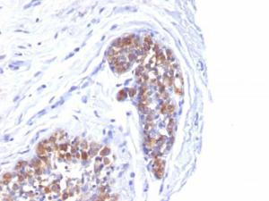 Immunohistochemical analysis of formalin-fixed, paraffin-embedded human breast carcinoma using Anti-MUC1 Antibody [MUC1/520]