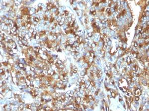 Immunohistochemical analysis of formalin-fixed, paraffin-embedded human breast carcinoma using Anti-MUC1 Antibody [MUC1/520]