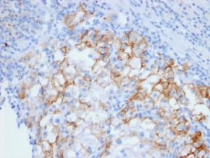 Immunohistochemical analysis of formalin-fixed, paraffin-embedded human renal cell carcinoma using Anti-Cadherin 16 Antibody [CDH16/2448]