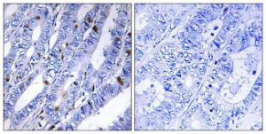 Immunohistochemical analysis of paraffin-embedded human colon carcinoma tissue using Anti-PKA-R2 beta Antibody The right hand panel represents a negative control, where the antibody was pre-incubated with the immunising peptide