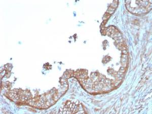 Immunohistochemical analysis of formalin-fixed, paraffin-embedded human prostate carcinoma using Anti-Calpastatin Antibody [CAST/1550]